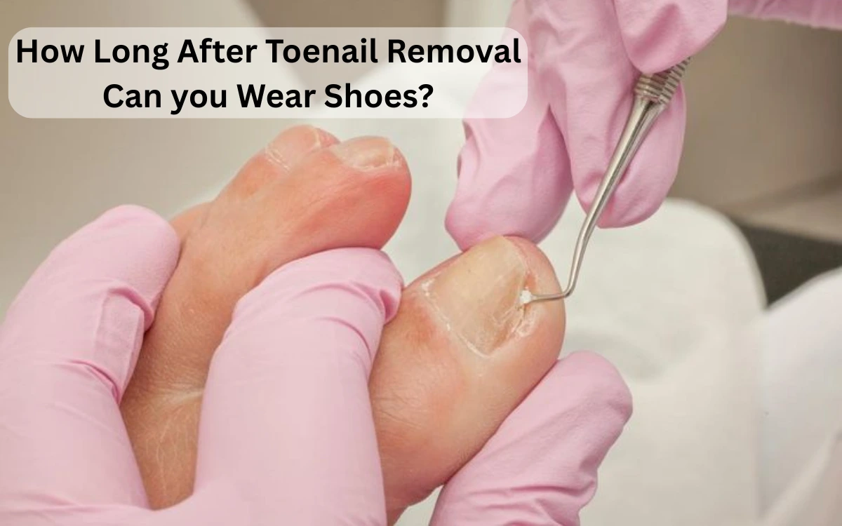 How Long After Toenail Removal Can I Wear Shoes? (Recovery Guide) Shoeaura
